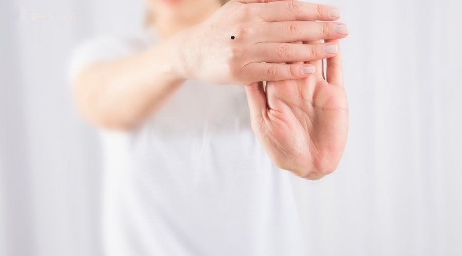 Nốt ruồi trên mu bàn tay